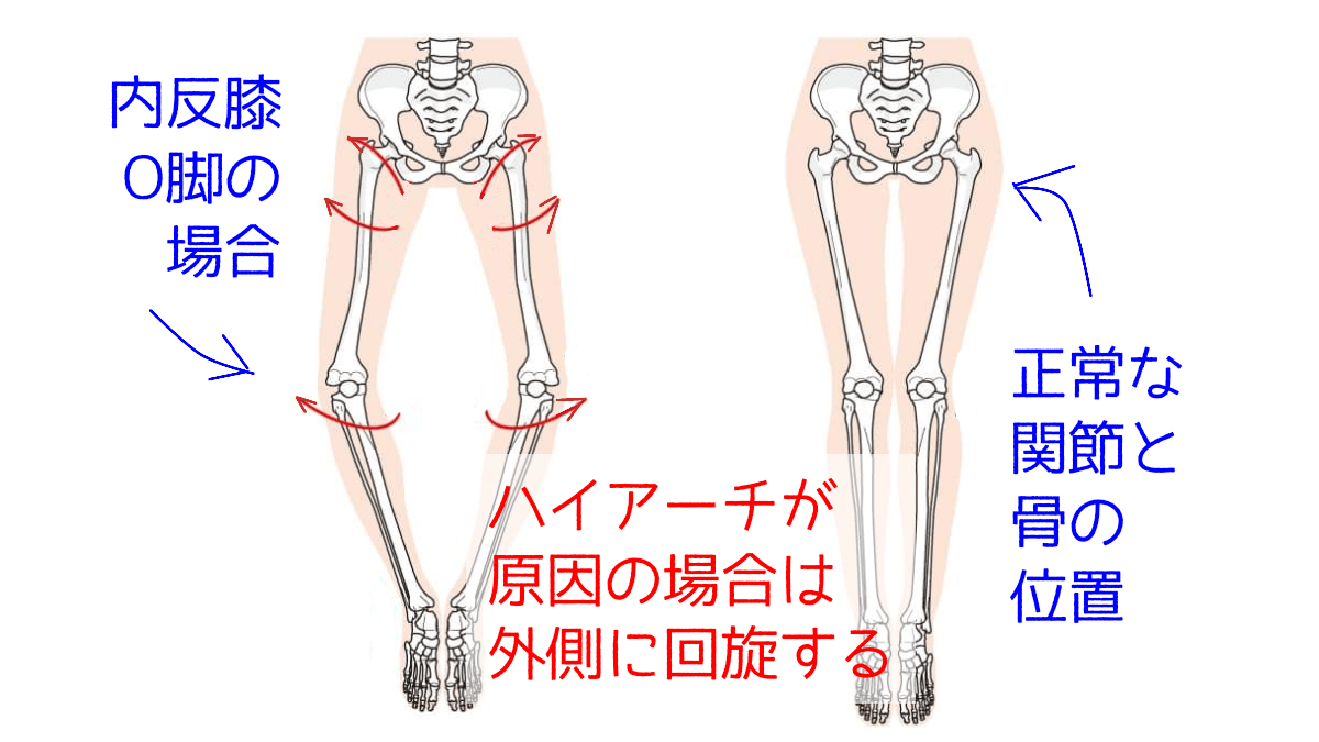 ハイアーチが原因の場合の内反膝