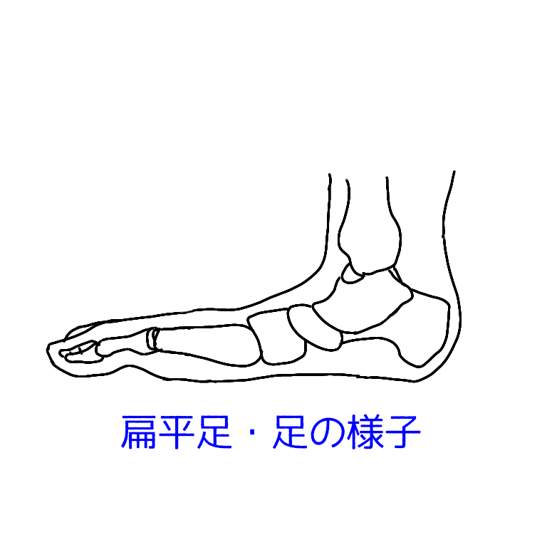 偏平足・足の様子