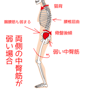 両側の中臀筋が弱い場合