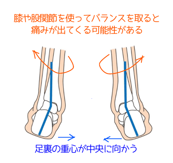 オーバープロネーション